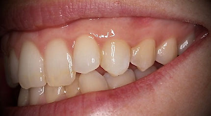 Single tooth is dark and discolored before and after natural results