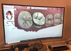 DigitalDentalCrown.jpeg