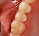Natural white tooth colored fillings, bonding cosmetic dentistry and cosmetic dentist to fix stained fillings