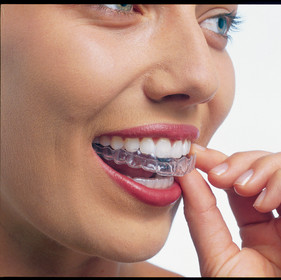 Clear Braces.jpg