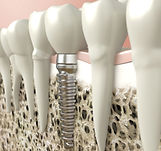 Dental Implant dentist and surgeon, all-on-four, all-on-six best dental implant dentist San Antonio care