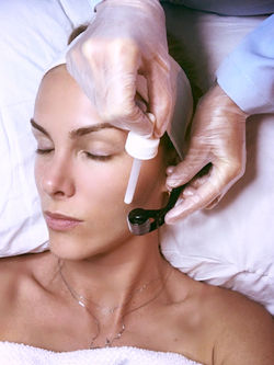 Ana - microagulhamento_edited_edited