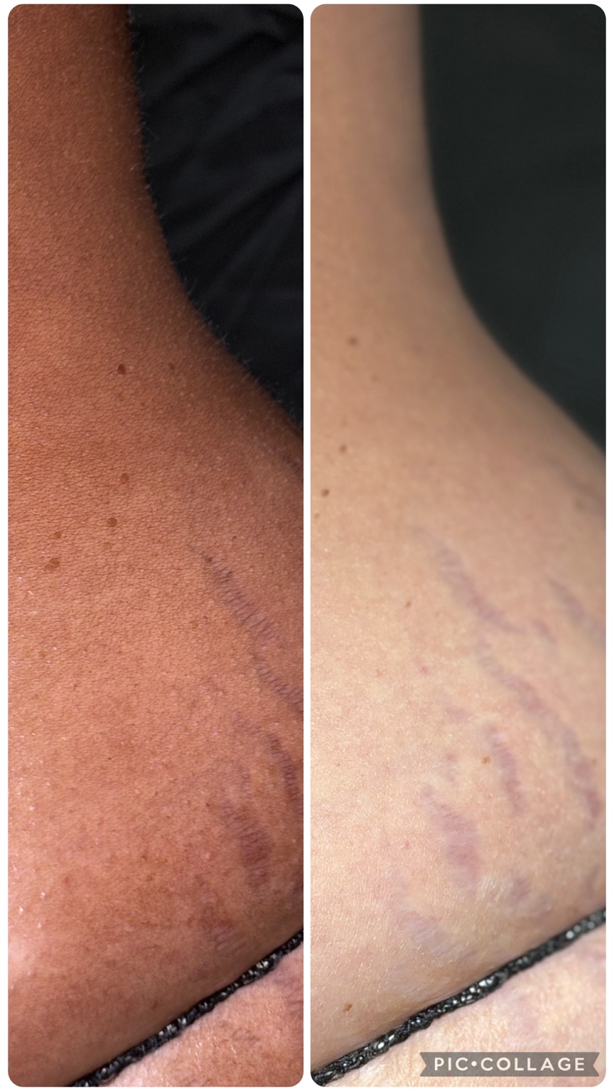 Side-by-side spray-tan comparison by Amanda Little