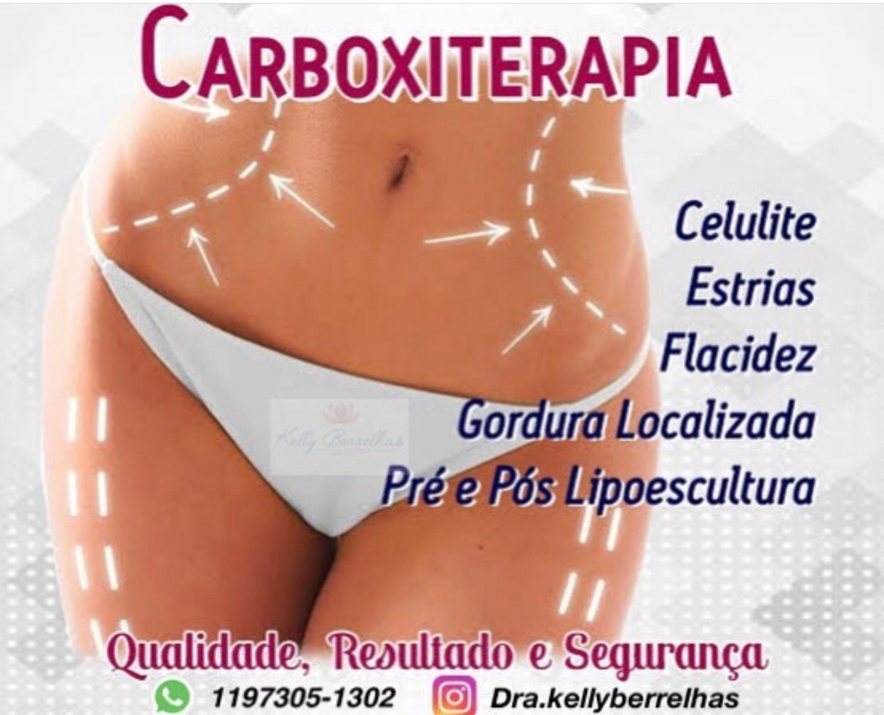 Carboxiterapia 