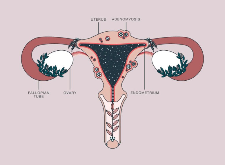 Picture of Image result for hysterectomy genetic testing for women