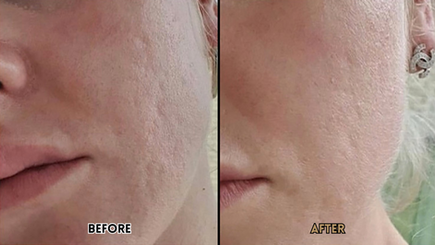 acne scaring treatment
