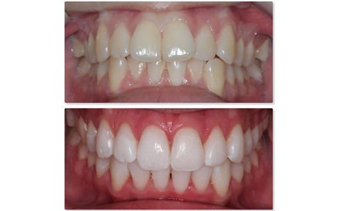 teeth whitening results