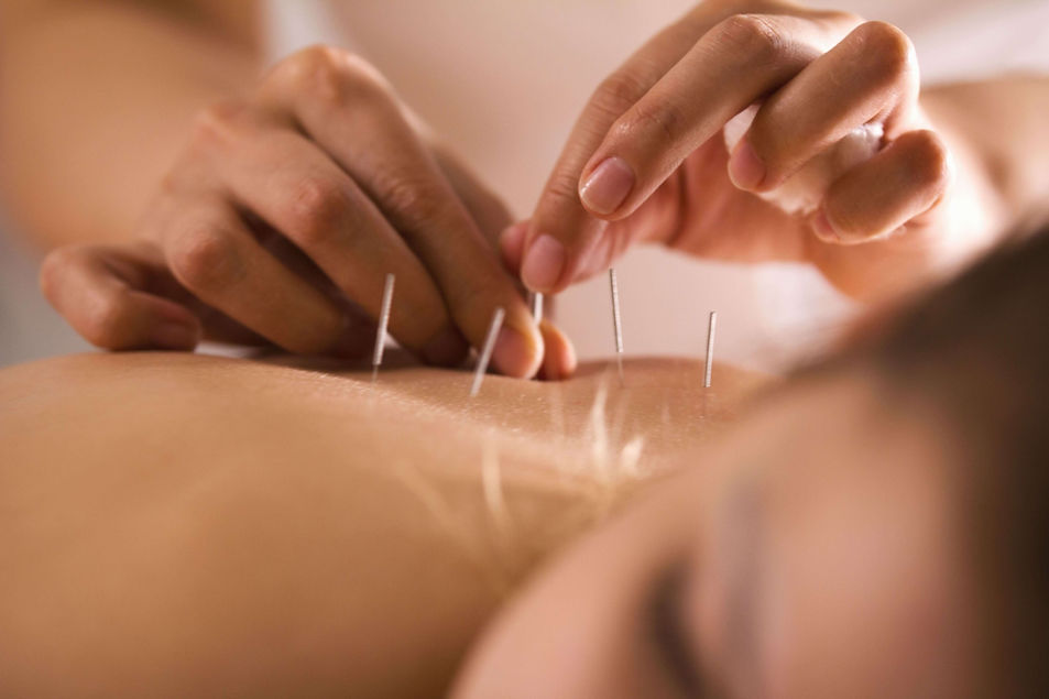 Acupuncture Treatments for Stress and Anxiety in Denver, CO.jpg