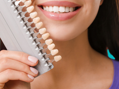 woman with composite veneers