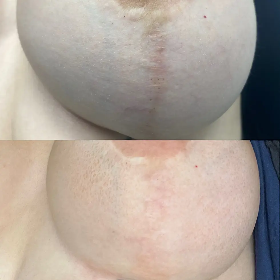 Breast-Scar-Skin-resurfacing-using-morpheus9.jpg.webp
