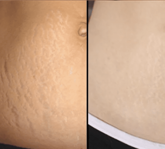 stretch-mark-removal-with-Morpheus8-in-belly-before-after-768x511.png