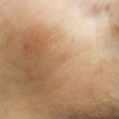 Na: pigment VPL behandeling