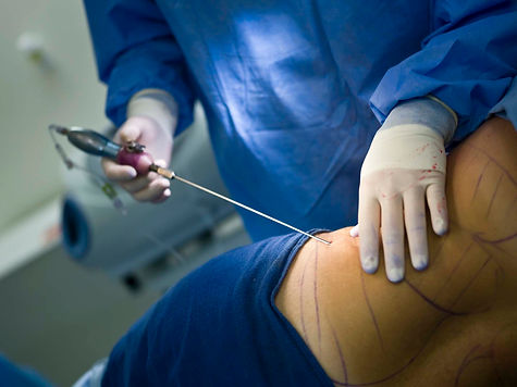 Liposuctie
