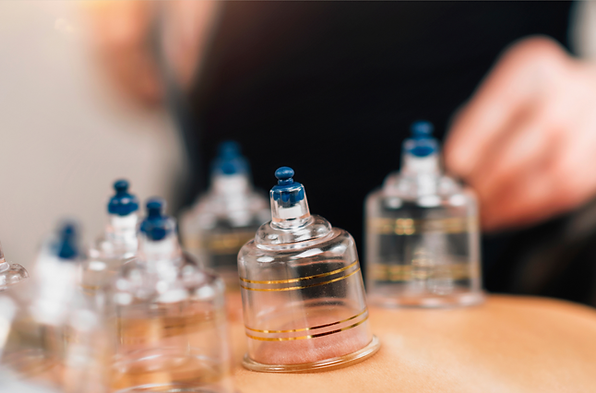 "Hijamah cupping therapy at home in Singapore"