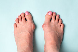 Nationa Bunion Day sponsored by Sole Bliss
