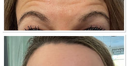 Dysport and Botox Treatment