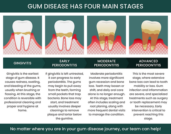 Gum disease has four main stages: Gingivitis, Early Periodontitis, Moderate Periodontitis, and Advanced Periodontitis. Gingivitis is the earliest stage of gum disease. It causes redness, swelling, and bleeding of the gums, usually when brushing or flossing. At this stage, the condition is reversible with professional cleaning and proper oral hygiene at home. If gingivitis is left untreated, it can progress to early periodontitis. The gums may begin to pull away from the teeth, forming small pockets that trap bacteria. Bone loss may start, and treatment usually involves deeper cleanings to remove plaque and tartar below the gumline. Moderate periodontitis involves more significant gum recession and bone loss. Teeth may loosen or shift, and daily oral care alone is no longer enough. At this stage, treatment often includes scaling and root planing, along with more frequent dental visits to manage the condition.Advanced periodontitis is the most severe stage, where extensive bone loss can