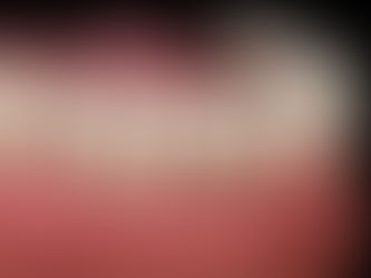 image of gum recession on mandibular teeth