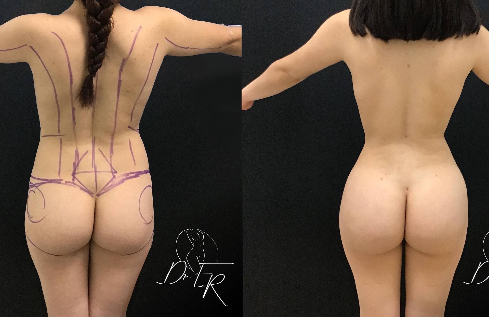 Ántes y Después Mommy Makeover por Erik Rodriguez Plastic Surgery Tijuana