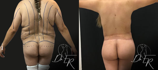 Before and After Tummy Tuck