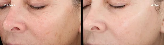 Skin Rejuvenation And Renewal