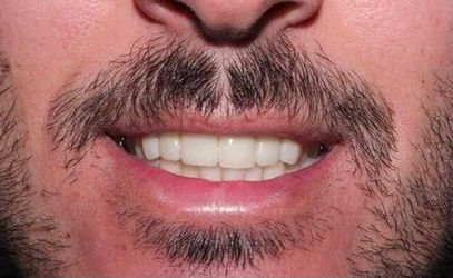 Man's smile after dental restoration