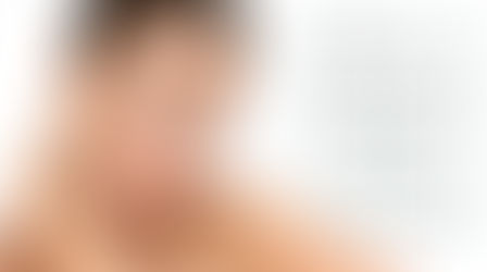 Do you have melasma?