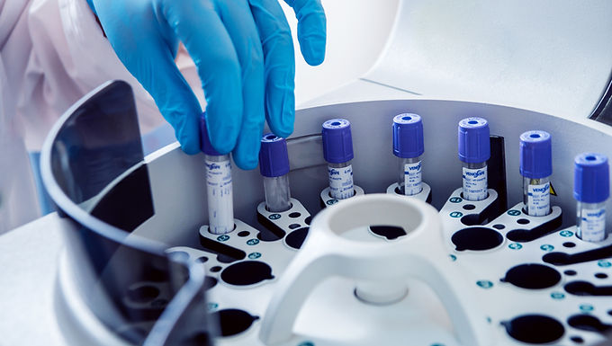 SLA - PROGETTO PILOTA SUL DNA MITOCONDRIALE CIRCOLANTE