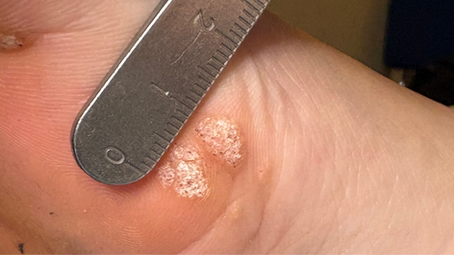 Close-up of a foot with two rough plantar warts (verrucae / verruca) measured by a metal ruler