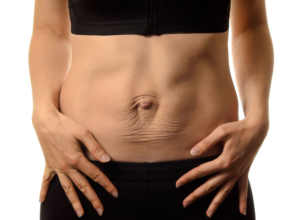 Tratamento da diástase abdominal: como recuperar a firmeza do abdômen com segurança