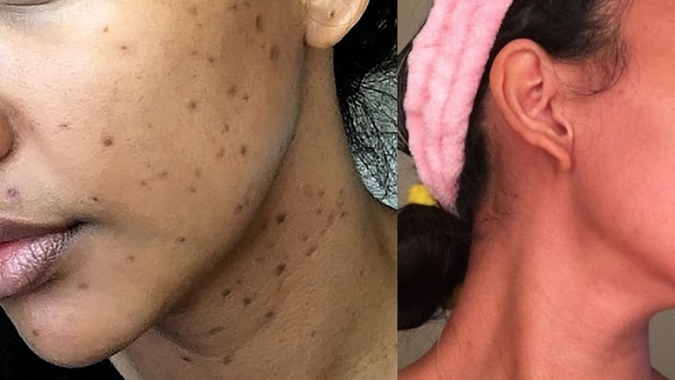 Hyperpigmentation:  The Facts