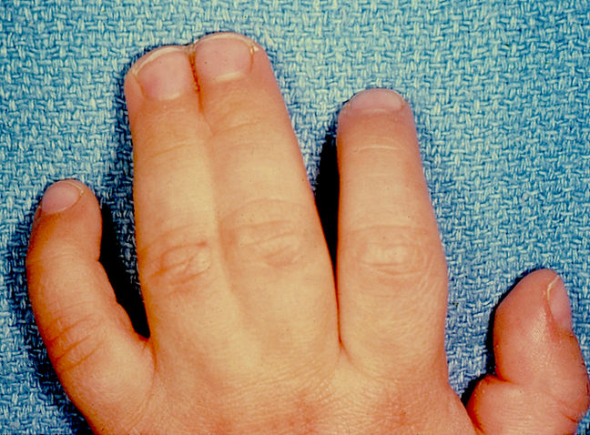 hand syndactyly