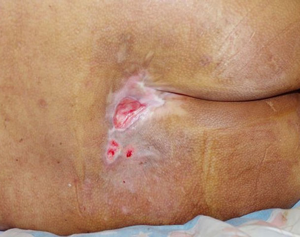 A sacral pressure sore.