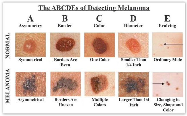 The ABCDE Criteria of Melanoma Detection.