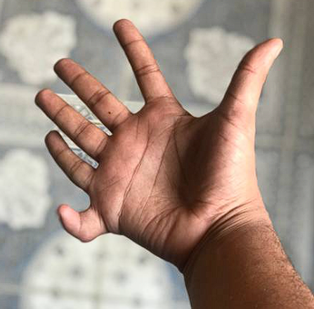 polydactyly little finger