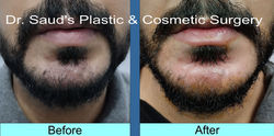 Chin Fat Grafting