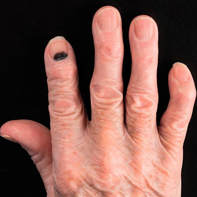 Malignant Melanoma