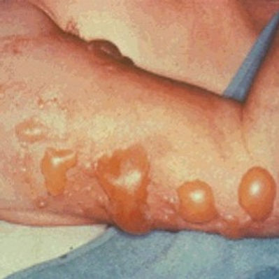 2nd Degree Superficial Burn