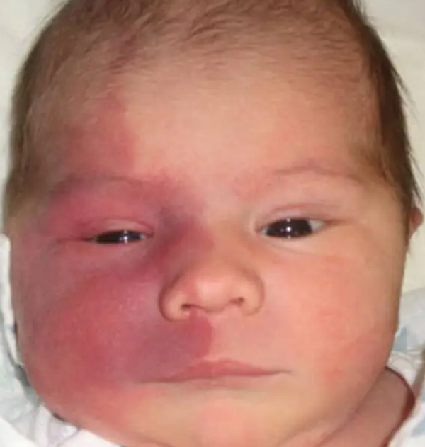 A baby with facial Capillary malformation