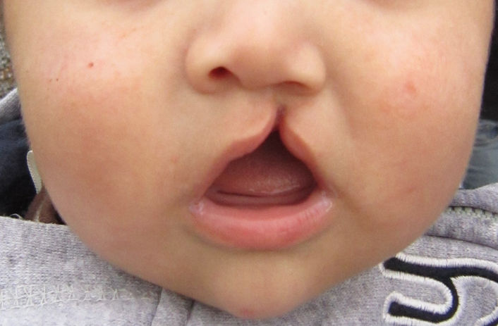 A baby with a unilateral cleft lip.