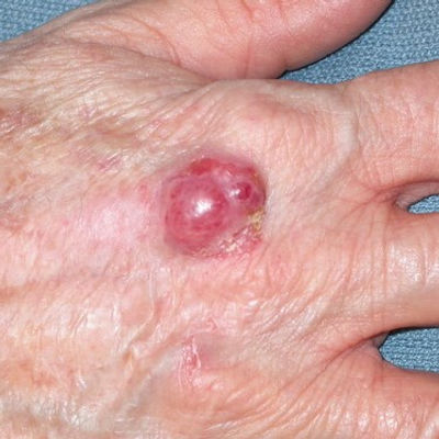 Merkel Cell Carcinoma