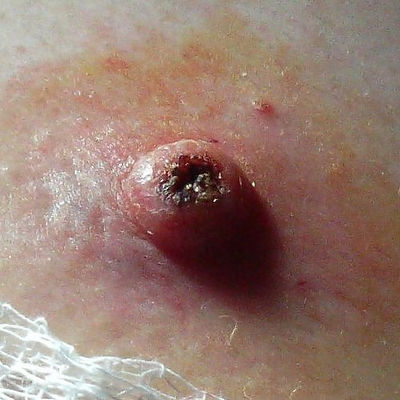 Keratoacanthoma