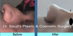 Rhinoplasty (Tip Projection)
