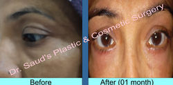 Lower Blepharoplasty