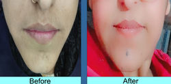 Jawline Fat Grafting