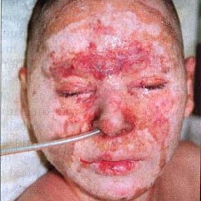 2nd Degree Deep Burn