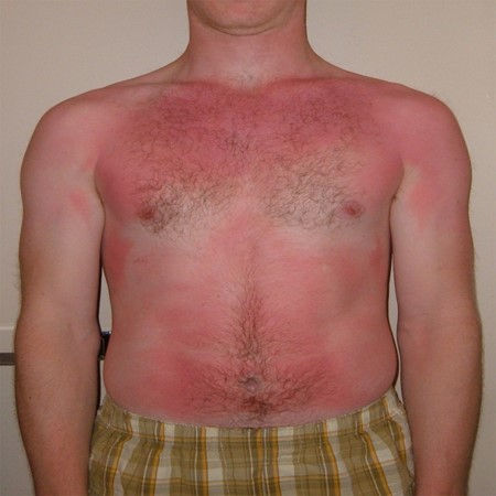 First degree burn.