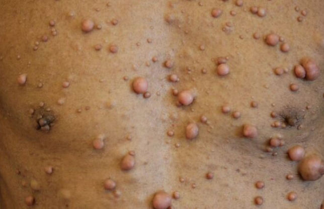 A boy with multiple small neurofibromas on the chest.