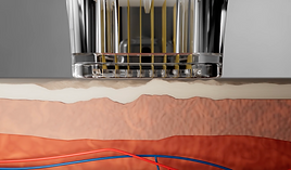 Skin Layer with RF Fractional Machine