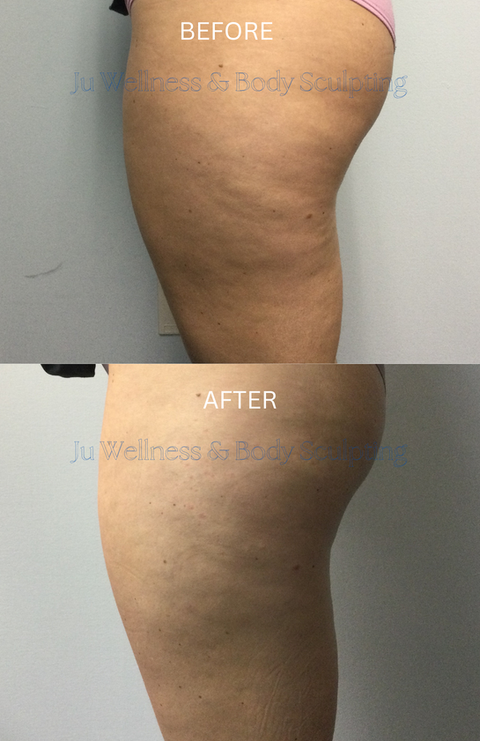 Client lost 1 1/2" in the abdomen in 2 weeks